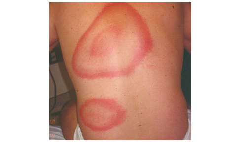 Bull's eye Lyme Disease lesion