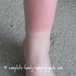 sunburned leg